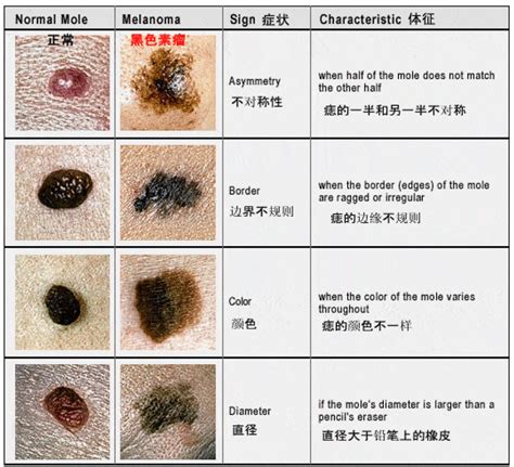 背部很多痣|痣也可能会癌变！长在 3 个地方要注意